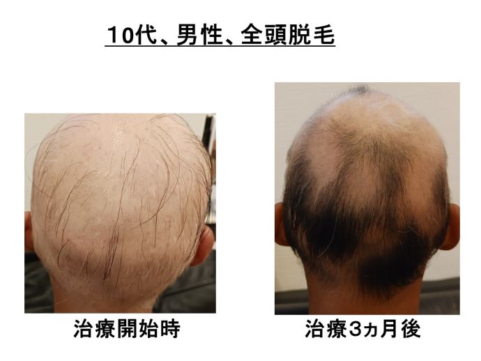 円形脱毛症　病院